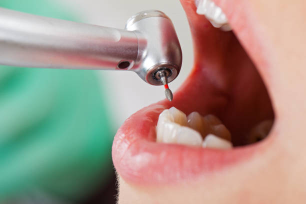 Best Emergency Dental Extractions in Clendenin, WV